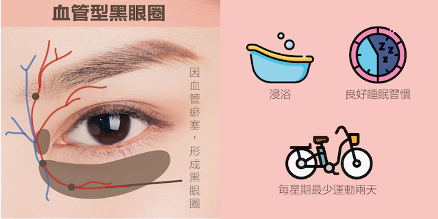 顏色呈青色/紅藍色/紅色,因為血液循環不良引致眼周肌膚泛青紅色。有三種人最容易出現這種:一,怕冷體質/血液循環不好的人,;二,運動不足/整天坐著不動的人;三,睡眠不足/生活作息不規律的人。為什麼血液循環不良會引發黑眼圈呢?因為眼周分布著很多靜脈毛細管, 靜脈負責回收代謝產品和毒素,如果循環差的話,毒素色素便堵塞毛細血管。