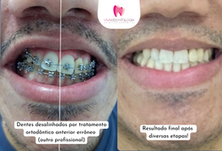 Dentes desalinhados por tratamento ortodôntico anterior errôneo (outro profissional).png