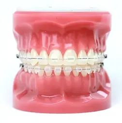 model_clear_braces.jpg.webp
