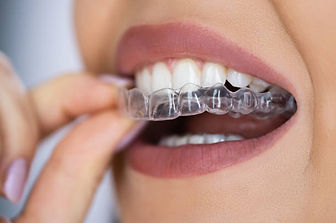 Essix Retainer.jpeg