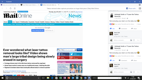 Adventures in tattoo removal Laser-lite Birstall West 