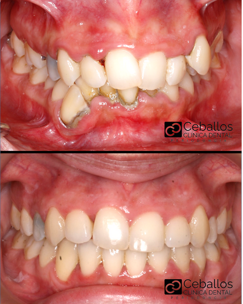 enfermedad periodontal caso de periodontitis