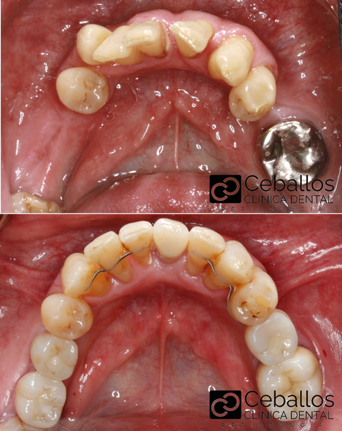 IMPLANTE ORTODONCIA IMPLANTE DENTAL
