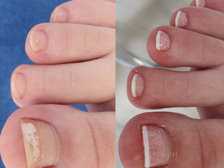 Weiße Flecken auf den Nägeln?