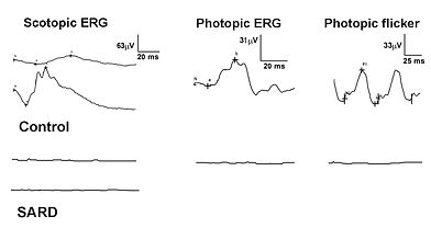 Abnormal retinal electrical response in a dog affected with Sudden Acquired Retinal Degeneration Syndrome - SARDS.