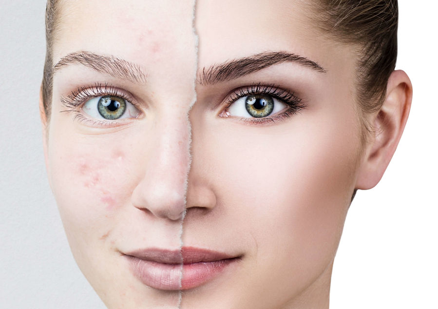 mikrodermabrasion.jpg