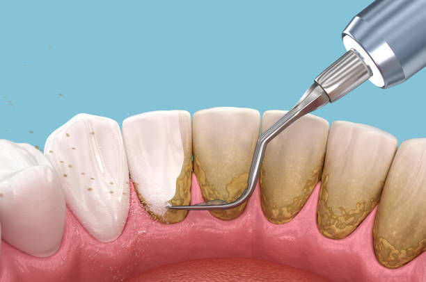 Remove Plaque and Tartar from Teeth