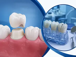 Dental Crowns