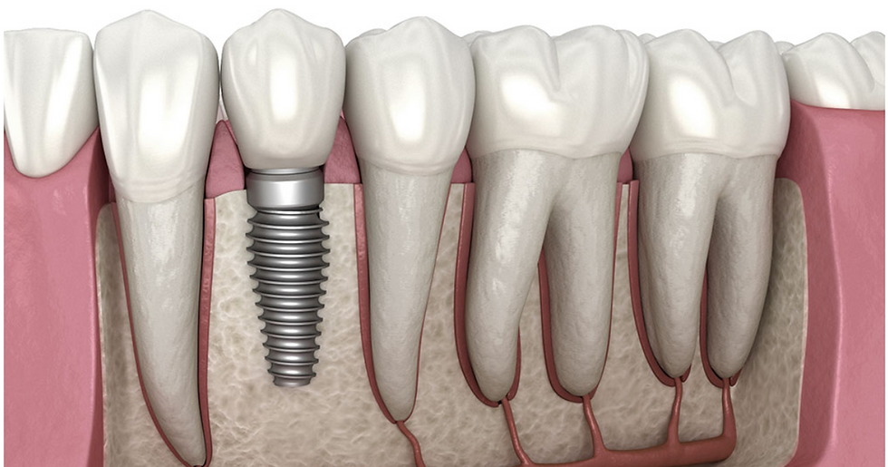 Replacing Missing Teeth Treatment in Campbelltown