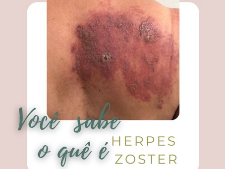 Você sabe o que é Herpes Zoster