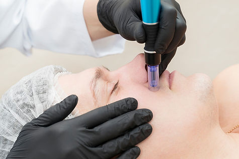 Microneedling Huntsville Al