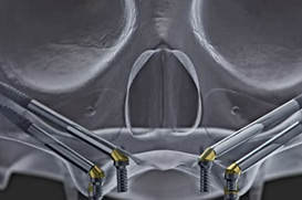 zygomatic course.jpg