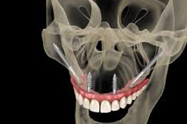 zygomatic course.jpg