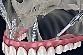 zygomatic course.jpg