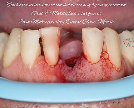 tooth removal near me.jpg