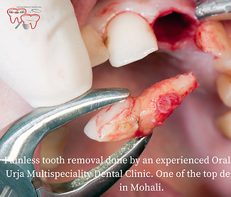 tooth extraction cost.jpg