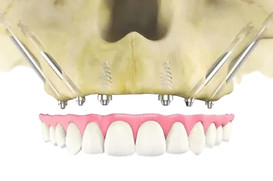 straumann zygomatic implant course.jpg