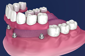 zygomatic course.jpg