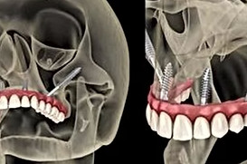 implant courses for general dentist.jpg