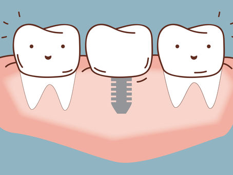 DENTAL IMPLANT