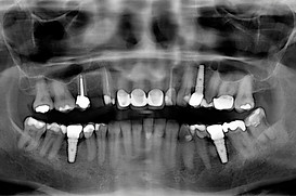 zygomatic implant course.jpg