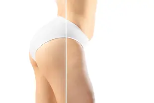 Anti-Cellulite-massage.webp