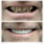 layered Zirconia crowns