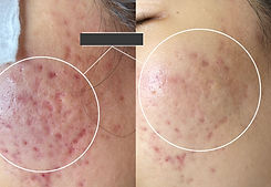 10_엑소_스피큘필링1회+엑소15698 mts 4회_edited_edited.jpg