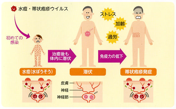 安田皮フ科_帯状疱疹