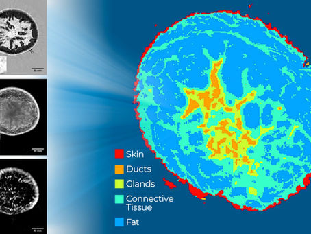 Understanding QT Breast Imaging: A Clinical Overview of Breast Acoustic CT™ Technology