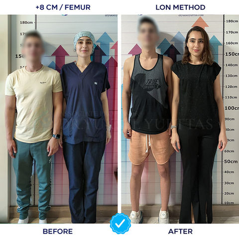 170 cm (5 feet 7 inches) to 178 cm (5 feet 10 inches) before and after femur limb lengthening surgery with LON method, +8 cm (3.1 inches) growth
