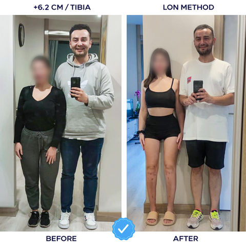158 cm (5 feet 2 inches) to 164.2 cm (5 feet 5 inches) before and after tibia leg lengthening with LON method, +6.2 cm (2.4 inches) height gain