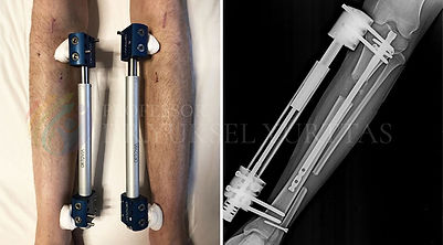 Image showing tibia lengthening procedure with the LON method