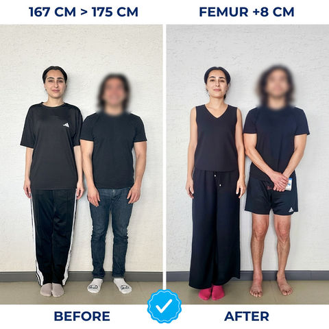 167 cm (5 feet 5 inches) to 175 cm (5 feet 9 inches) height before and after femur limb lengthening surgery, +8 cm (3.1 inches) height increase at age 50