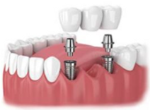 Fix denture bridge.png