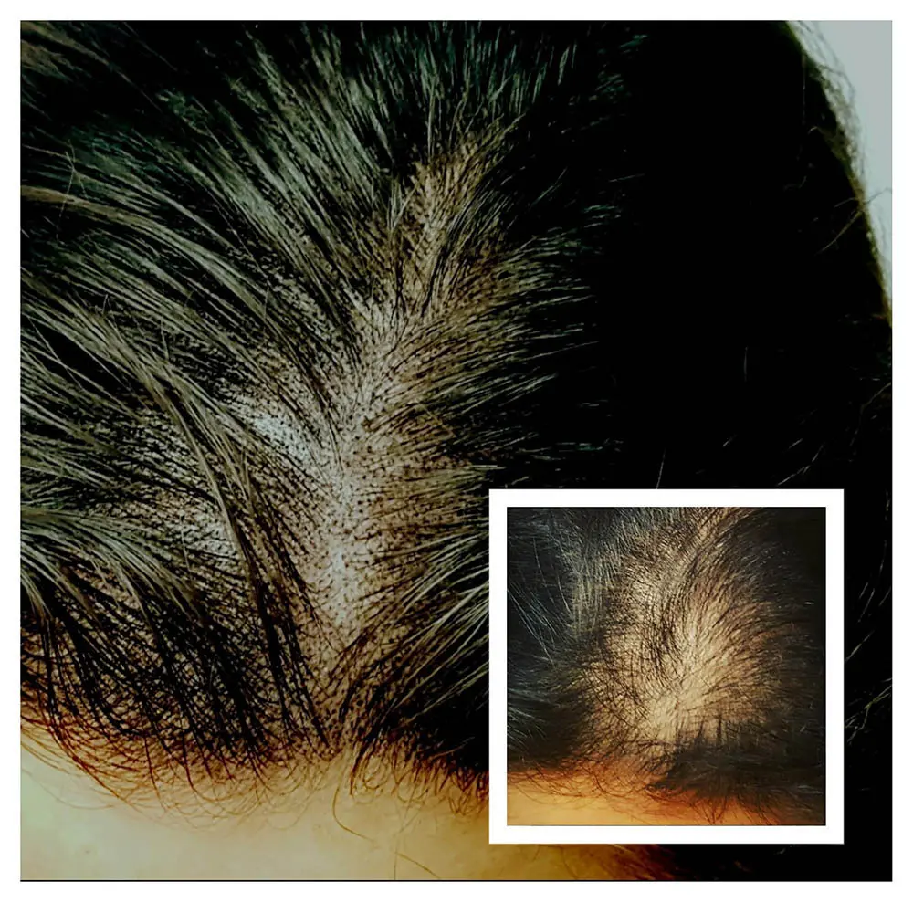 Scalp Micropigmentation