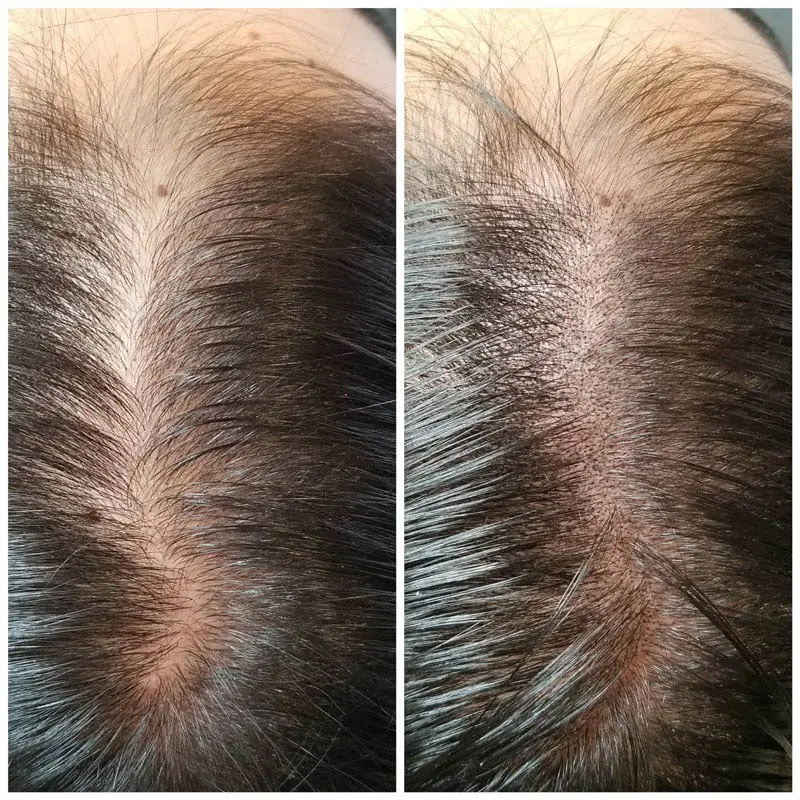 Scalp Micropigmentation