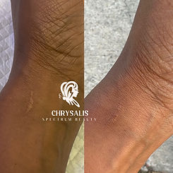 Scar revision wrist.jpeg