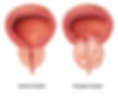 Comparison of normal and enlarged prostate showing pressure on the urethra.