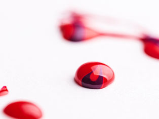 Exploring the Link Between Hematuria and Enlarged Prostate