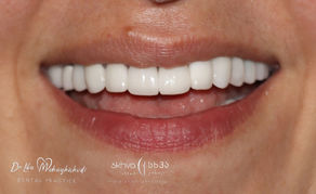 A Fully Digital Complex Case by Dr. Lika Mebagishvili