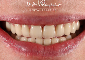 Veneers - Smile to tell a story