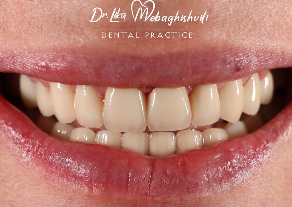 Veneers - Smile to tell a story