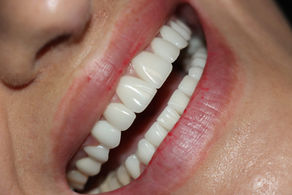 Porcelain Veneers