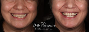 The Ultimate Guide to Dental Porcelain Veneers and Zirconium Crowns