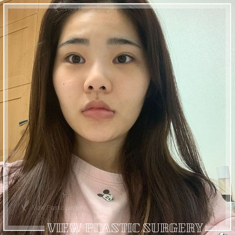 ศัลยกรรมตาที่ไหนดี