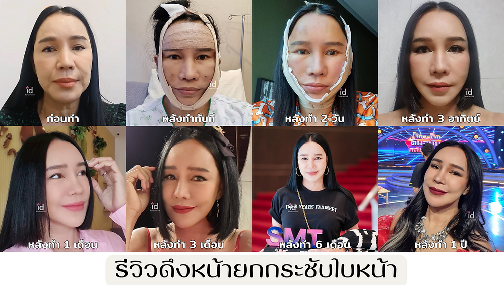 ดึงหน้ายกกระชับใบหน้า
