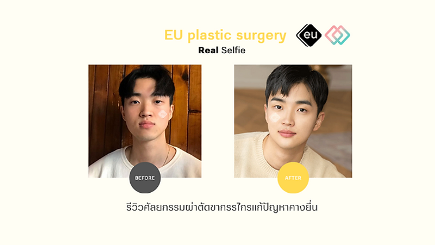 รีวิวศัลยกรรมผ่าตัดขากรรไกรเพื่อแก้ไขปัญหาคางยื่น โรงพยาบาลศัลยกรรมอียู