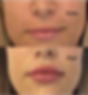 FillerOk