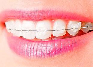 autoligado ocludent.jpg